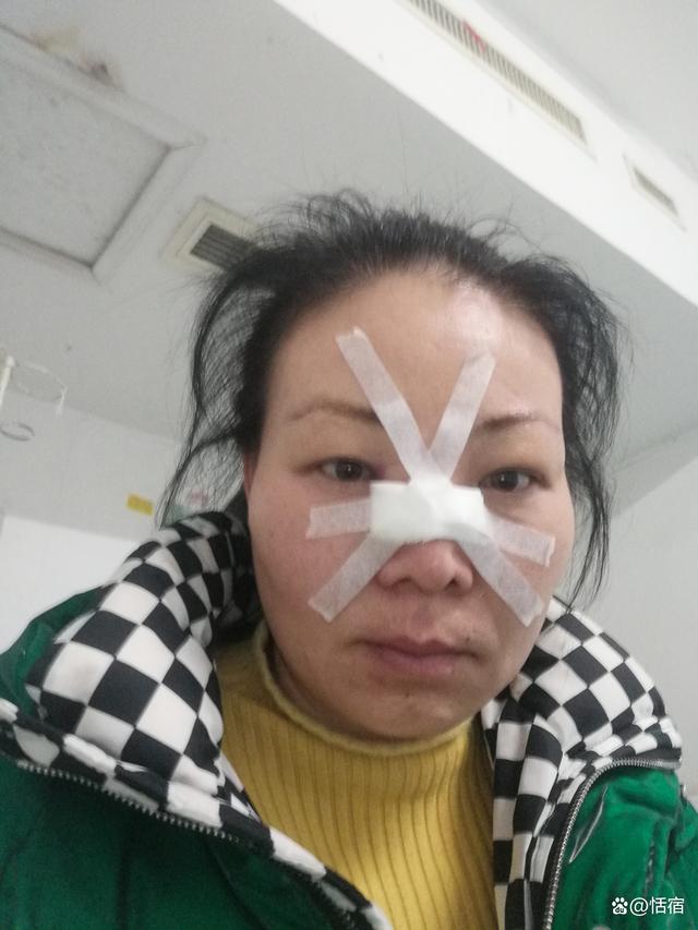 女子鼻骨骨折消肿后喜提高鼻梁，重塑自信之美